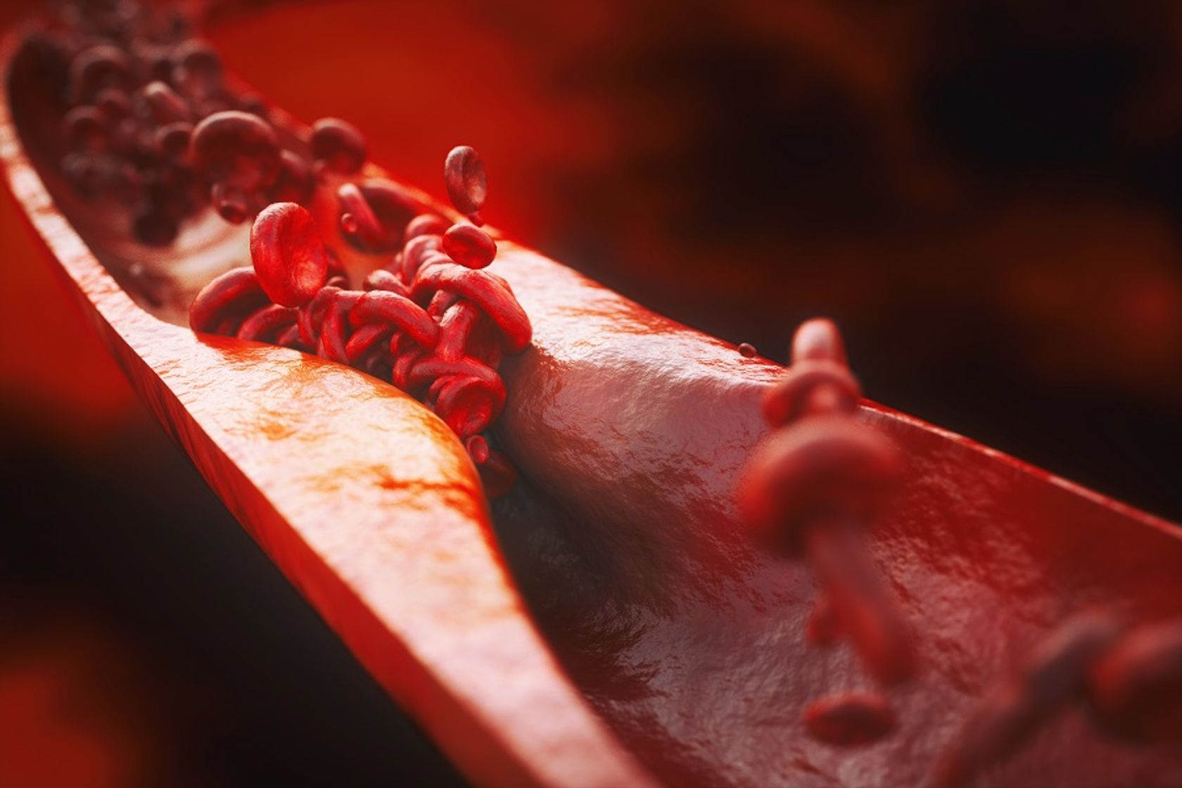 Thrombose: Verklumpung von Blutblättchen