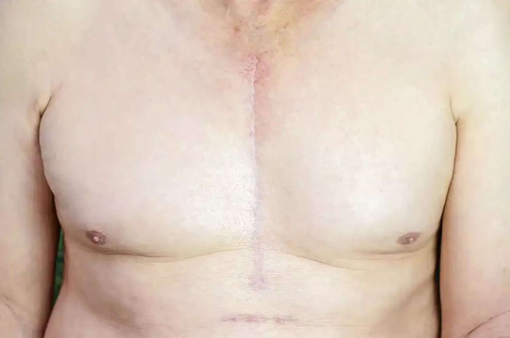 Männliche Brust mit Narbe einer Herz-Operation