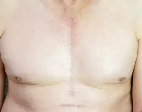 Männliche Brust mit Narbe einer Herz-Operation