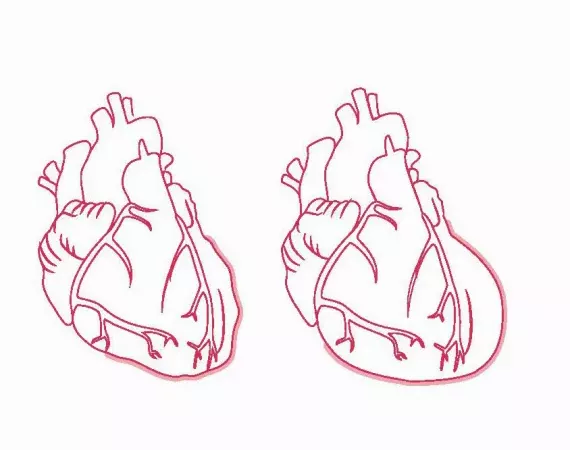 Bleibt bei einem zuvor gesunden Herzen (links) eine Myokarditis unerkannt, kann u. a. eine Kardiomegalie (rechts) die Folge sein.