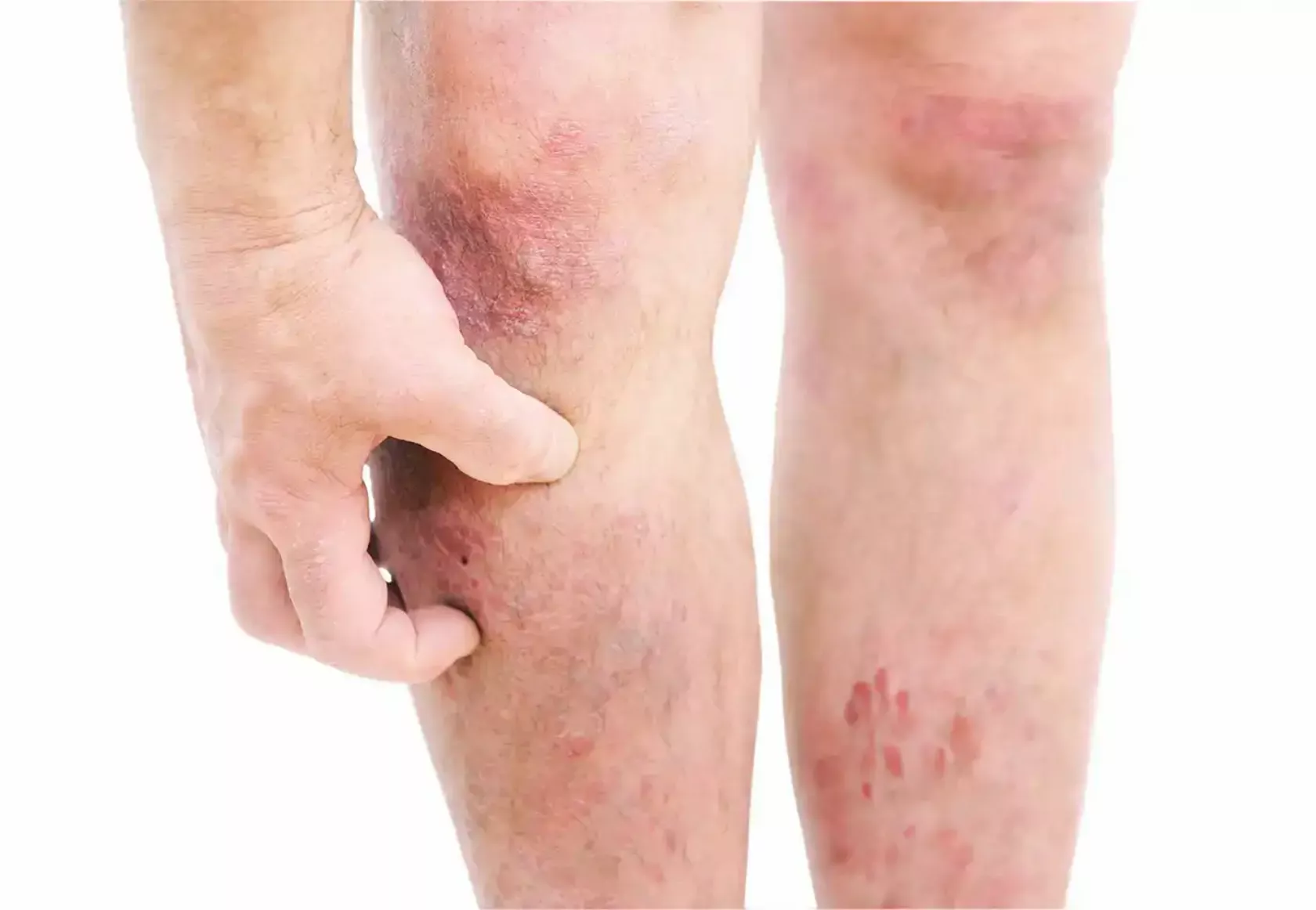 Von atopischer Dermatitis Betroffener kratzt sich am Bein, die Beine sind voller Hautveränderungen.