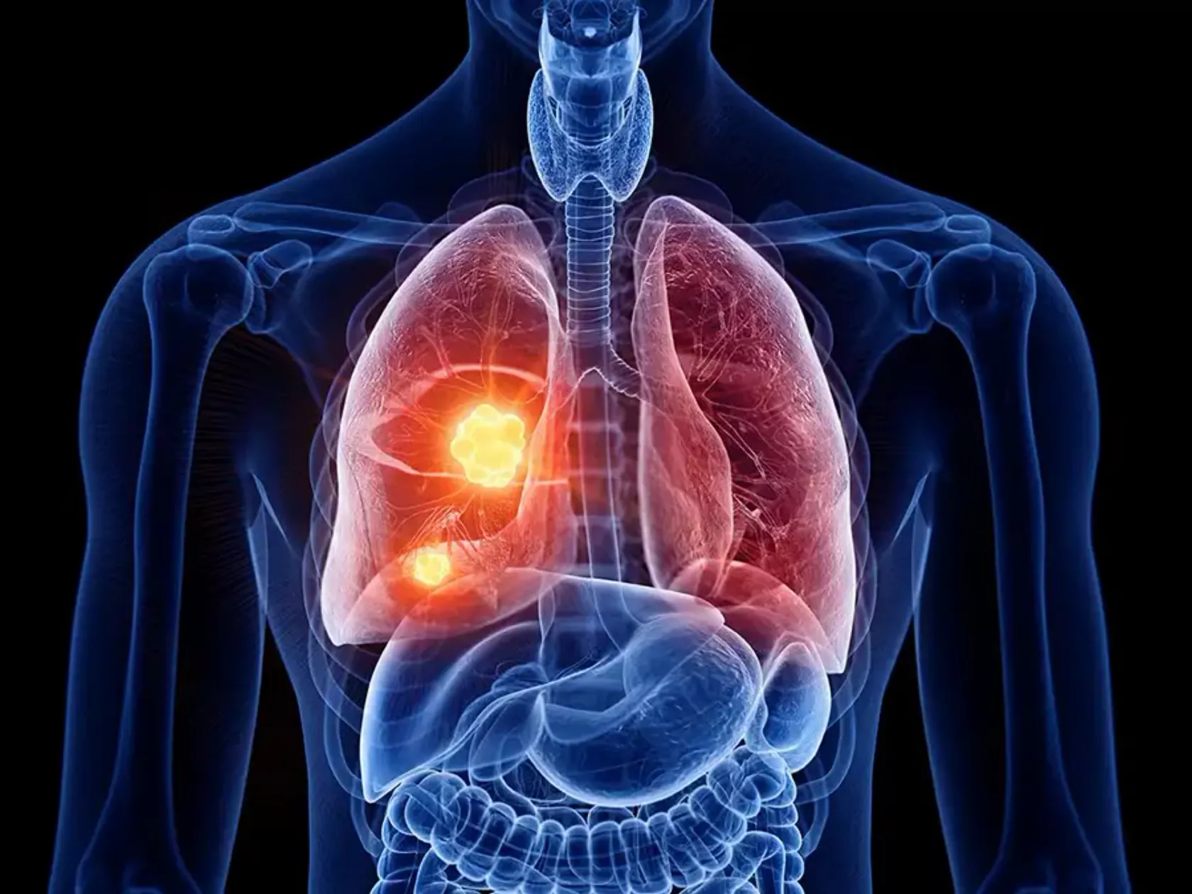 COPD in der Lunge - 3D Visualisierung