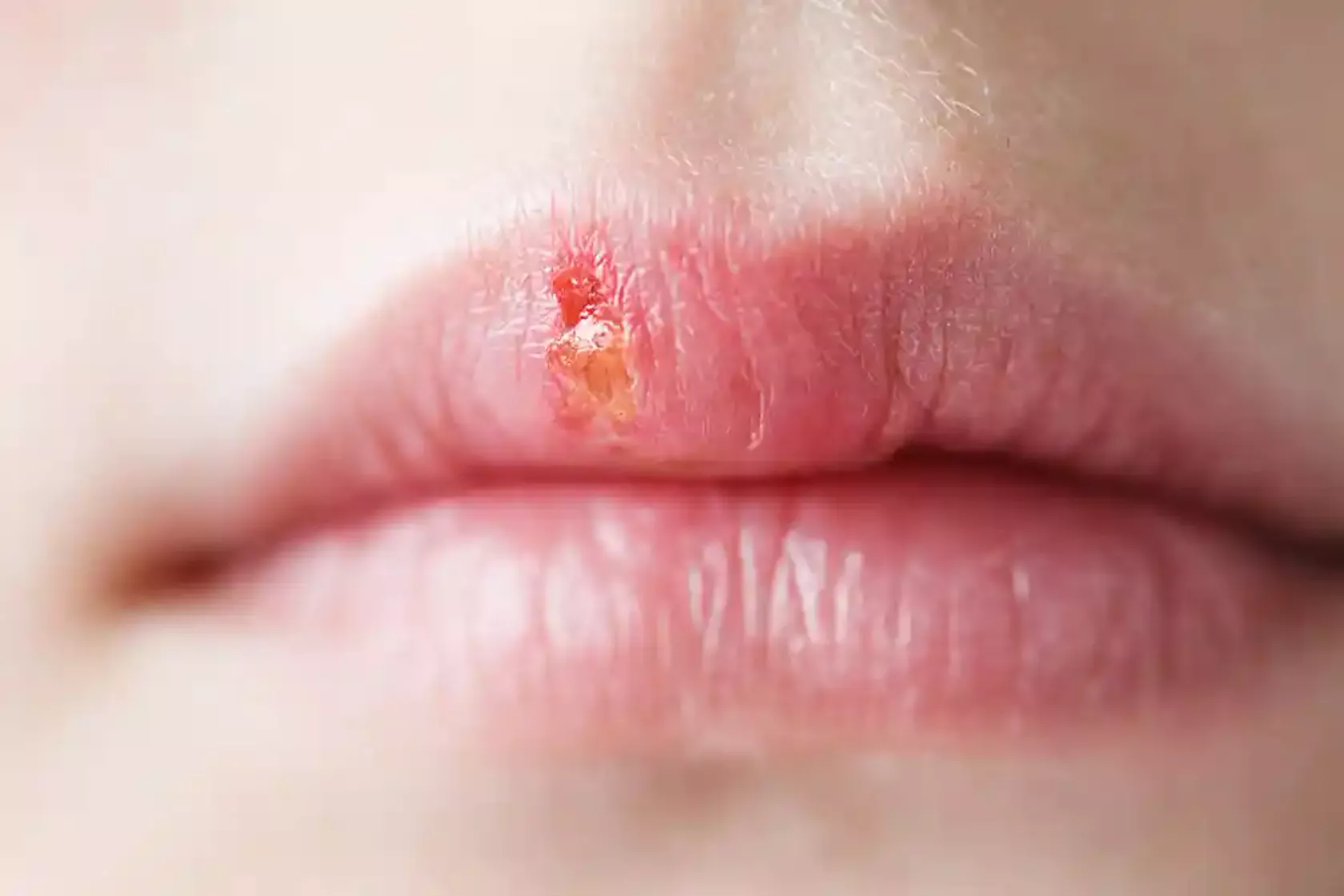 Lippen mit Herpes simplex (Bläschen)