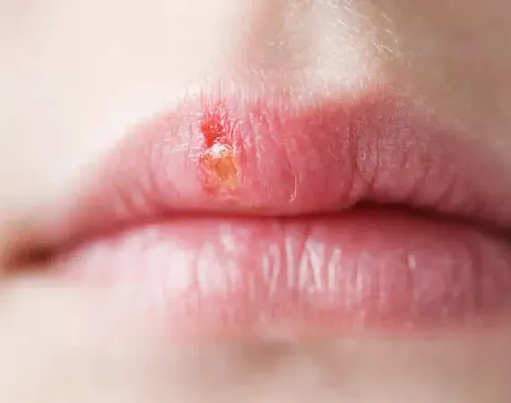 Lippen mit Herpes simplex (Bläschen)