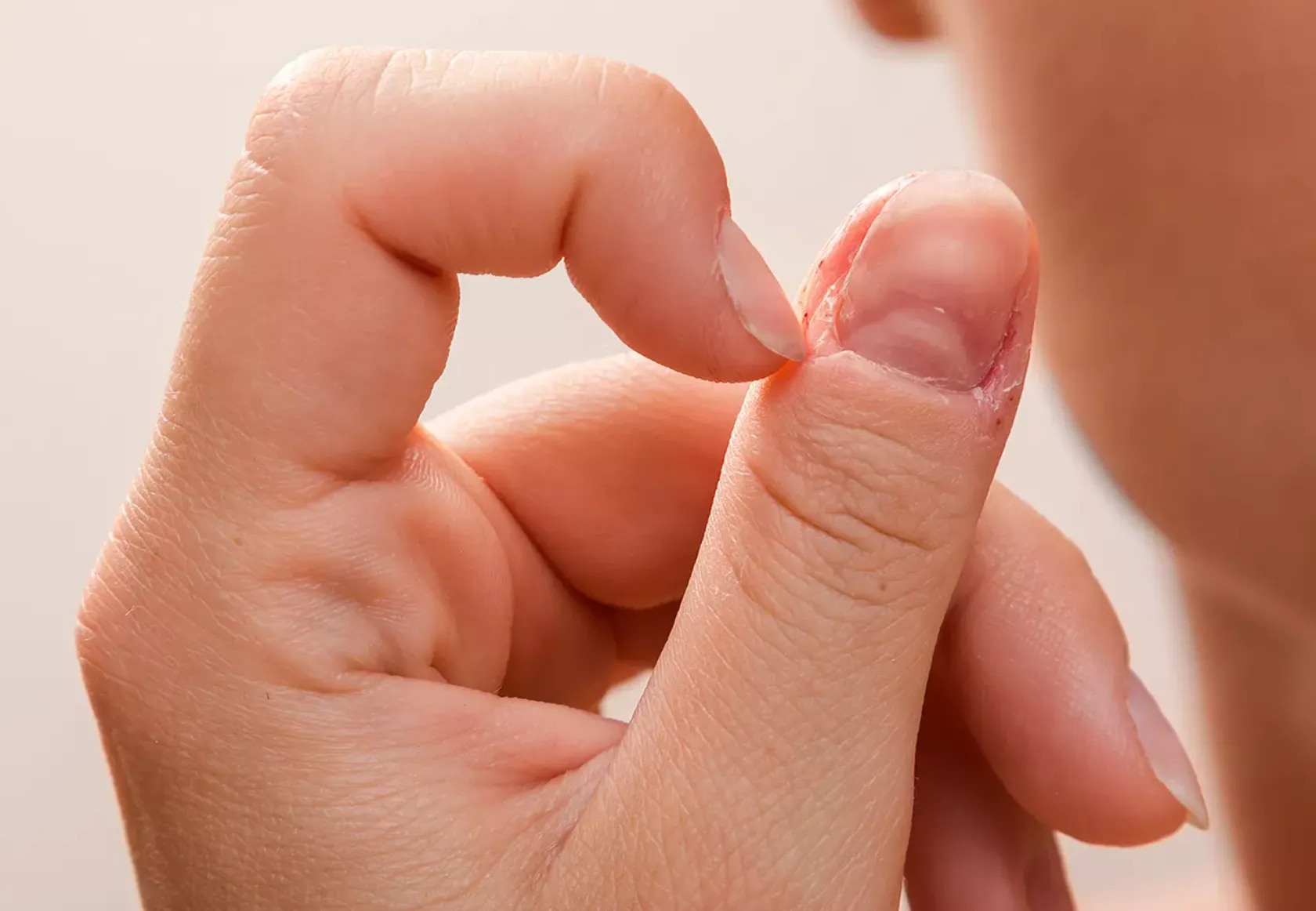 Person kratzt mit dem Fingernagel neben einem anderen Nagel, wo die Haut schon aufgekratzt ist.