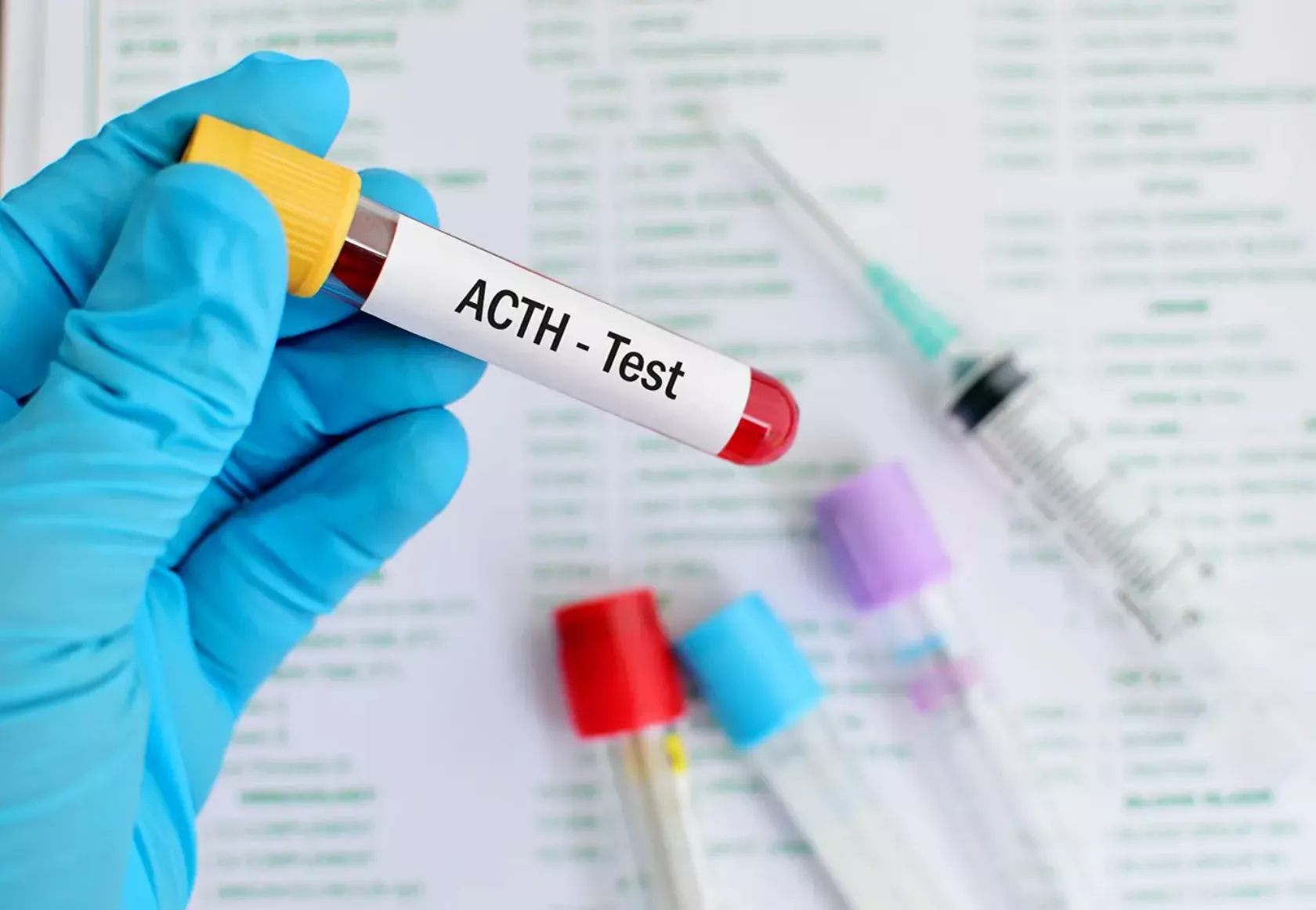 ACTH-Teströhrchen in der Hand der Arztes