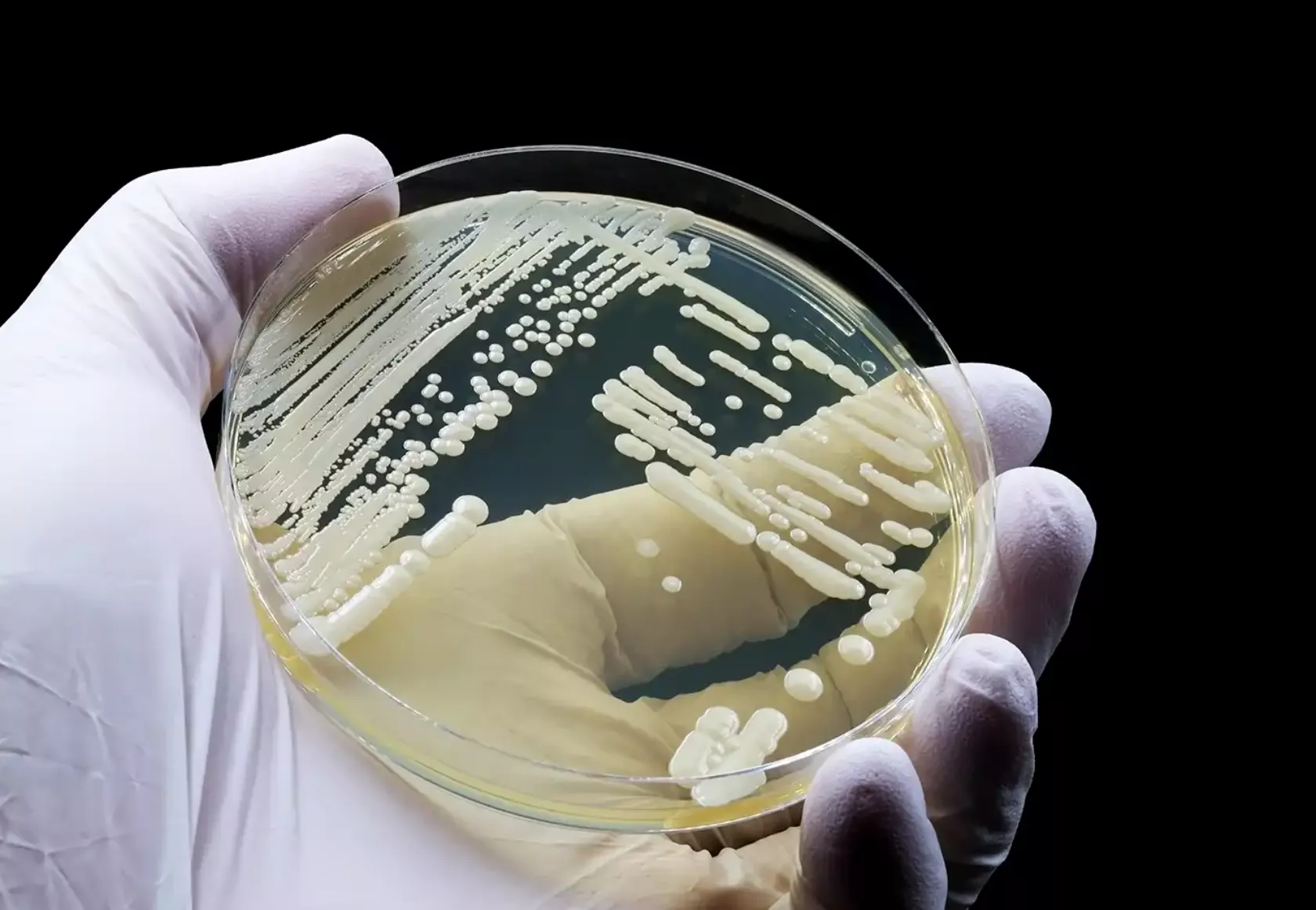 Mediziner oder Person im Labor hält eine Petrischale, in der eine Pilzkultur ist von Candida auris, verantwortlich für Harnwegsinfektionen.